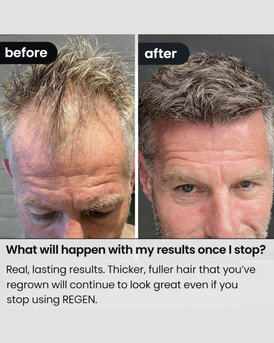 REGEN - Hairline Support Formula